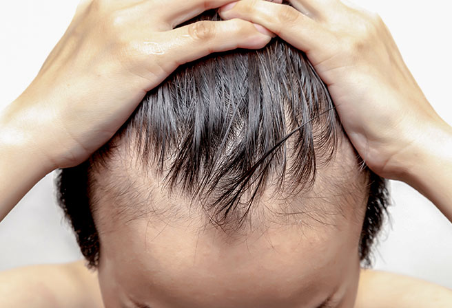 Mann mit Haarverlust Oberkopf